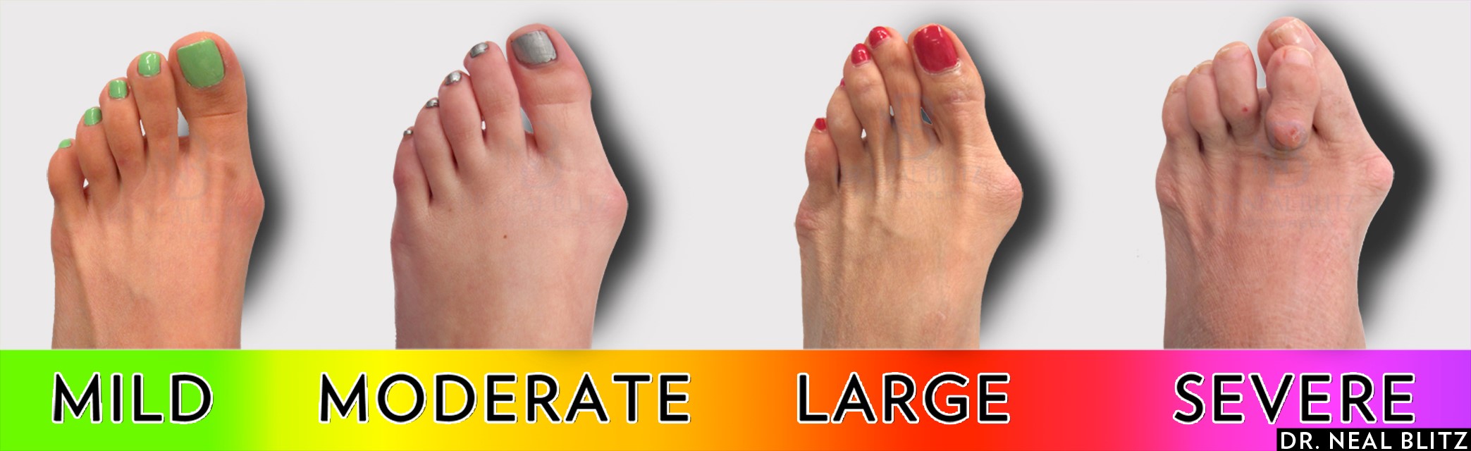 stages of a bunion